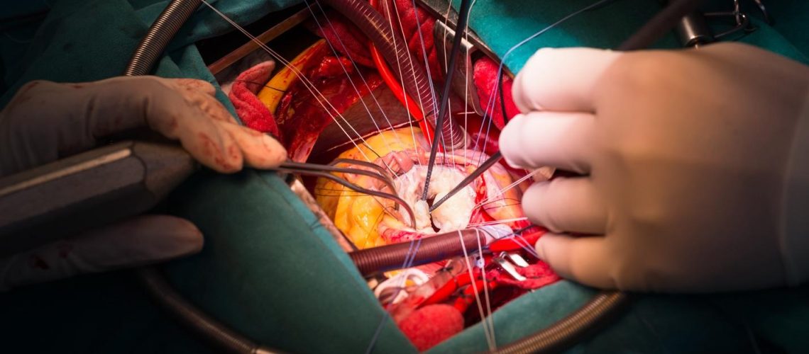 دکتر تعویض میترال در مشهد